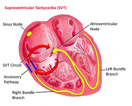 Supraventricular Tachycardia